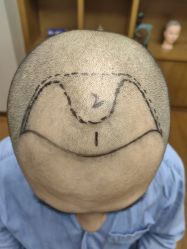 体验前-大麦微针植发全国连锁