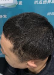 -碧莲盛·不剃发植发