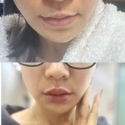 体验前-苏州维多利亚美容医院