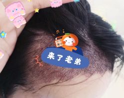 -大麦微针植发全国连锁