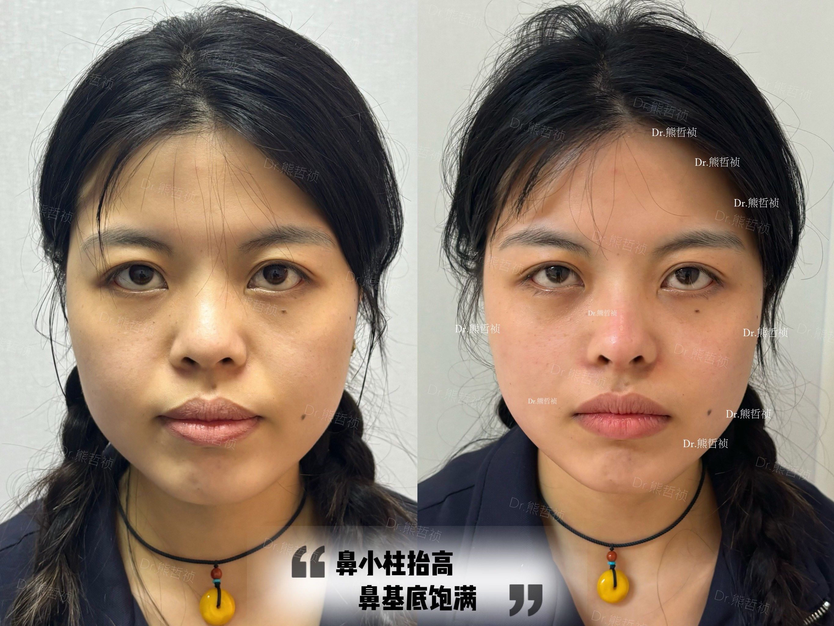 玻尿酸隆鼻 医美入坑不踩雷 我要变美变好看