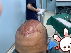 -大麦微针植发丨全国连锁