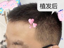 -大麦微针植发全国连锁