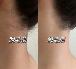 -薇兰专业脱毛连锁机构