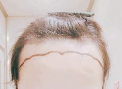-大麦微针植发全国连锁