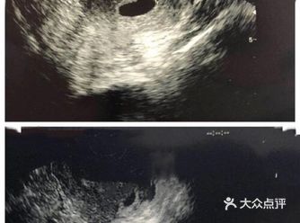 为什么会出现胎停育和空囊，到底是怎么回事？