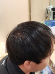 -碧莲盛·不剃发植发