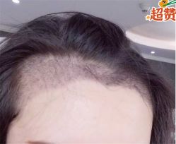 -大麦微针植发全国连锁