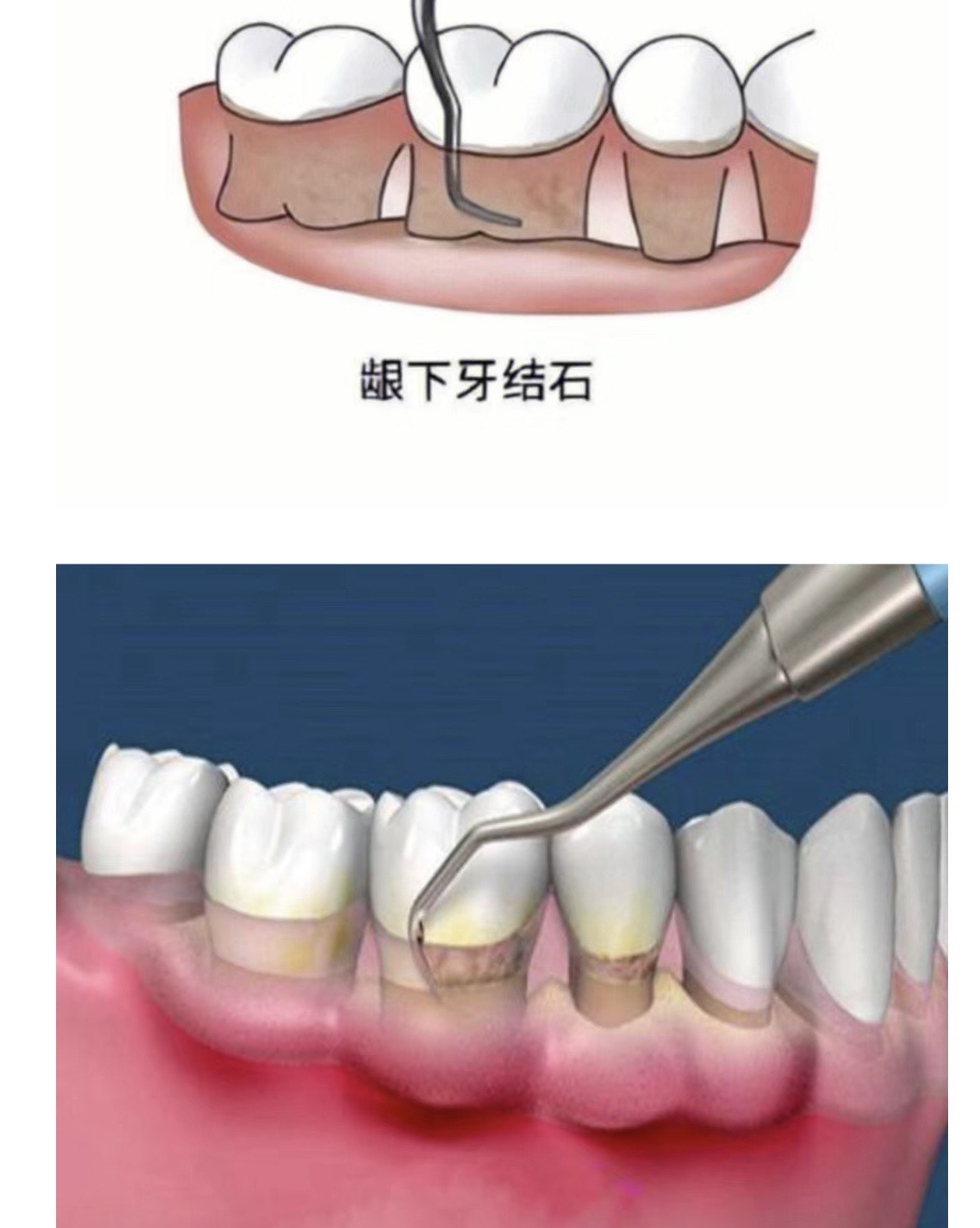 龈下刮治前后对比照片图片