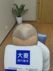 -大麦微针植发全国连锁