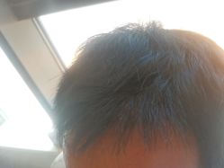 -碧莲盛·不剃发植发