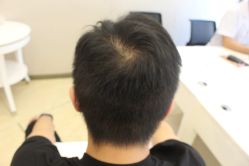-大麦微针植发丨全国连锁