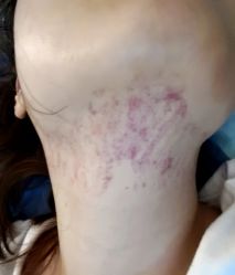 体验后-叶美人医疗美容