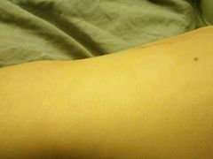 扎肿的左手-北京市健宫医院