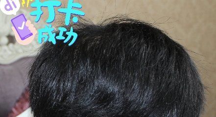 -大麦微针植发全国连锁