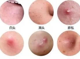 -蕾特恩·专业祛痘国际连锁