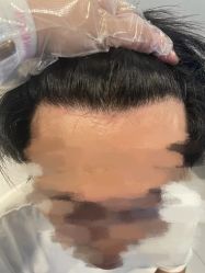 -大麦微针植发全国连锁
