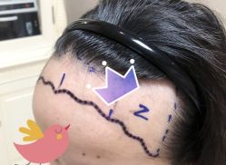 -大麦微针植发全国连锁