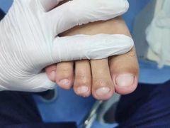 -Andrew指甲专科灰指甲·甲沟炎矫正·3D步态矫形鞋垫定制(浦三路店)