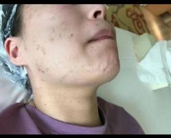 体验前-爱莎扁平疣·汗管瘤·斑痣中心