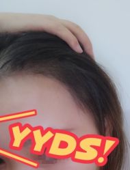 -大麦微针植发丨全国连锁