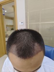 -大麦微针植发丨全国连锁