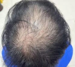 -大麦微针植发丨全国连锁