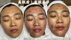 -美肤盾祛痘·问题肌头疗管理中心