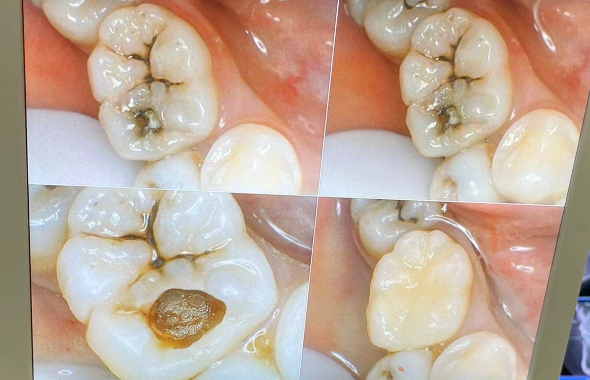门牙龋坏,楔状缺损,看看你的牙齿是哪种情况,如果发现蛀牙趁早补牙
