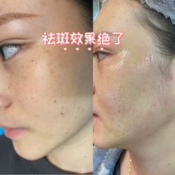 -美丽人生祛斑扁平疣汗管瘤中心