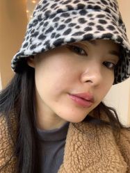 体验后-More摩尔医美の注射线雕光电中心