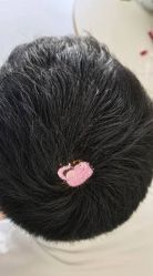 -大麦微针植发丨全国连锁