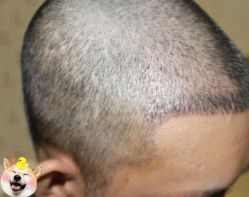 -大麦微针植发丨全国连锁