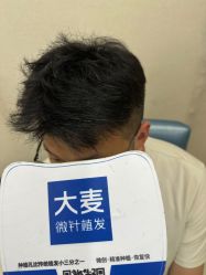 体验后-大麦微针植发丨全国连锁