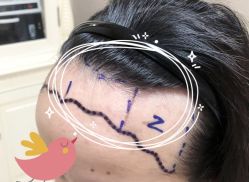 -大麦微针植发全国连锁