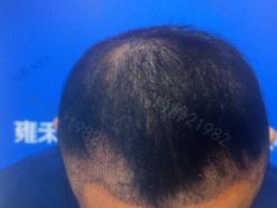 -雍禾植发全国连锁