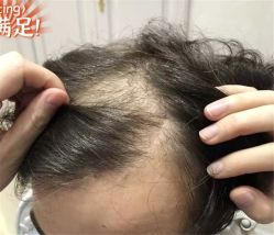 -大麦微针植发全国连锁