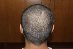 点击看大图 -大麦微针植发丨全国连锁