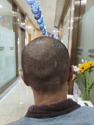 -大麦微针植发全国连锁