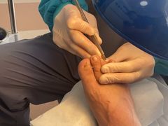 -世龙世家灰指甲鸡眼脚气甲沟炎跖疣护理(通州店)