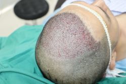 -大麦微针植发丨全国连锁