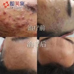 -靓芙泉专研痘痘肌