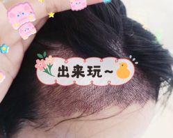 -大麦微针植发全国连锁