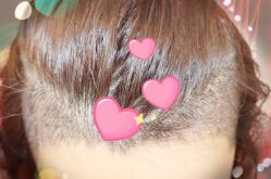 -大麦微针植发全国连锁