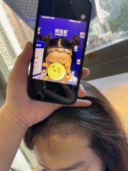 -碧莲盛·不剃发植发