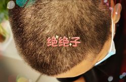 -大麦微针植发全国连锁