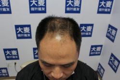 -大麦微针植发丨全国连锁