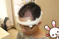 -大麦微针植发丨全国连锁