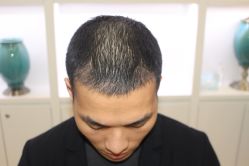 -大麦微针植发丨全国连锁