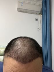 体验后-大麦微针植发全国连锁